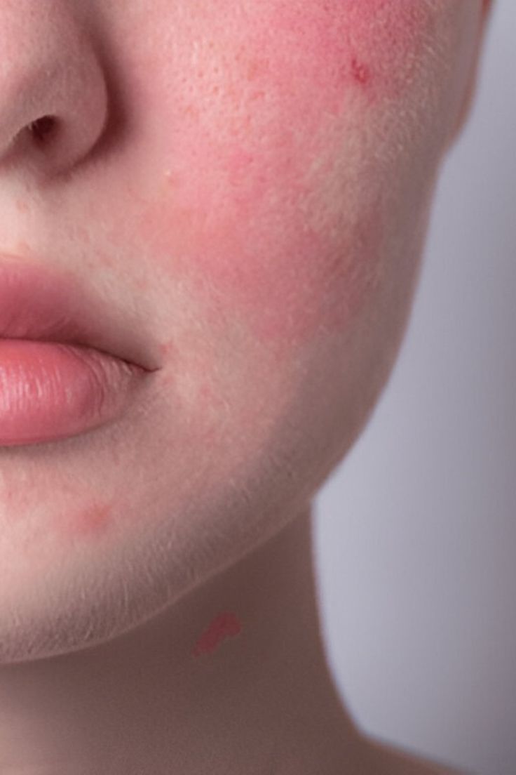 Redness & Sensitivity الاحمرار والحساسية