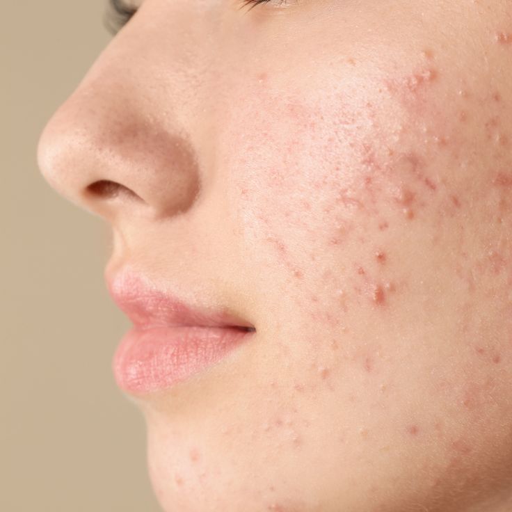 Active Acne الحبوب النشطة