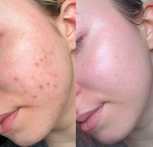 Anua Azelaic Acid 10 + Hyaluron Redness Soothing Serum