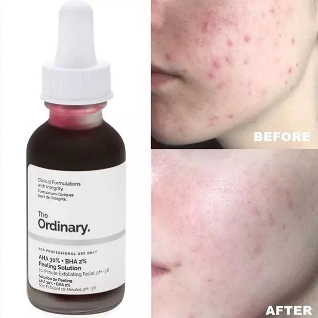 The Ordinary AHA 30% + BHA 2% Peeling Solution